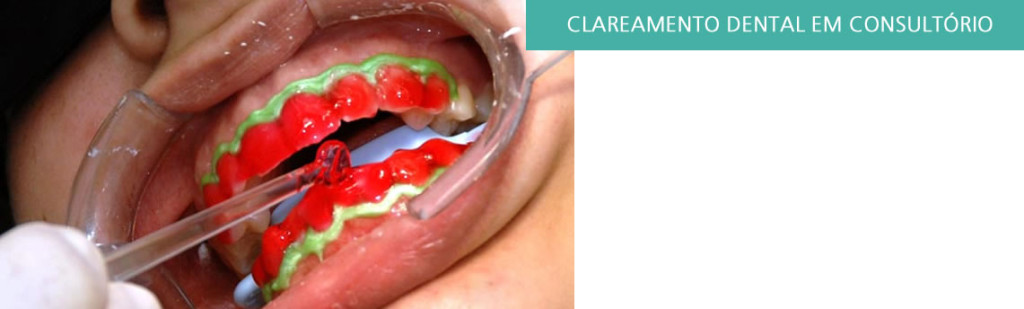 CLAREAMENTO-DENTAL4